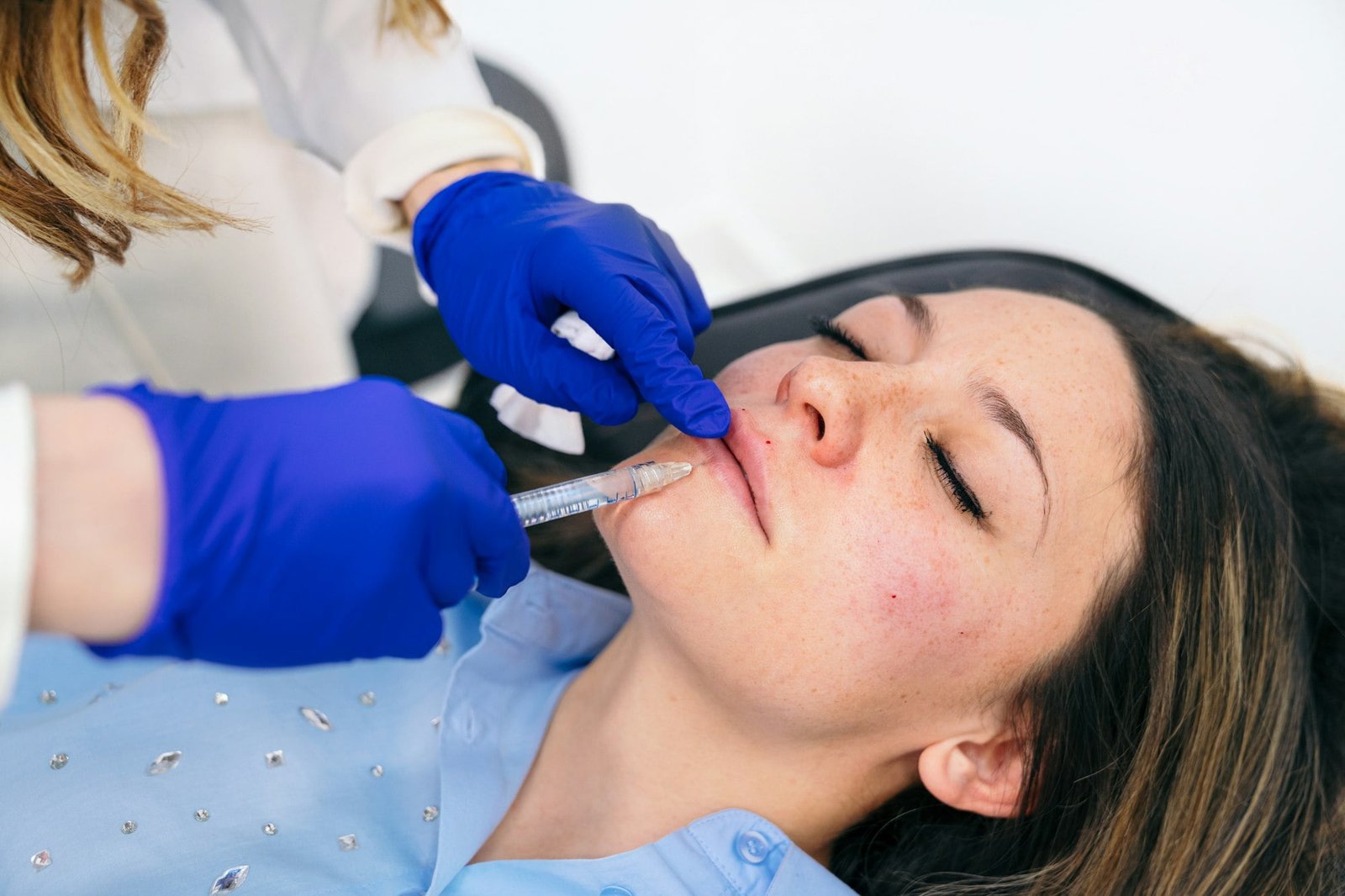 Enhancing Lower Lip with Precision Hyaluronic Acid Injection